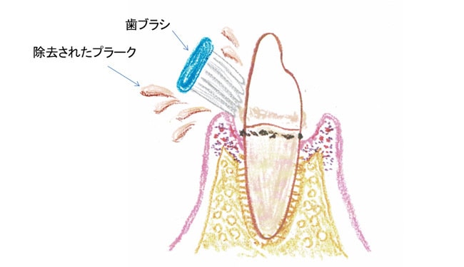 ブラッシング（歯磨き）