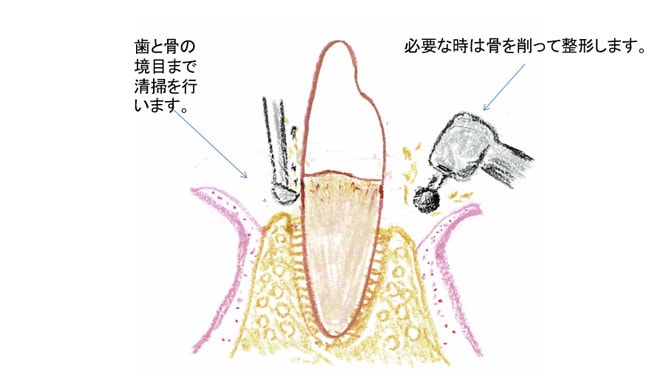 歯周外科（フラップ手術）